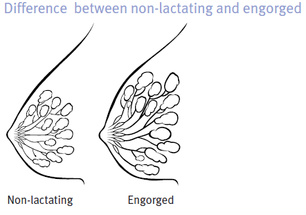 BREAST ENGORGEMENT